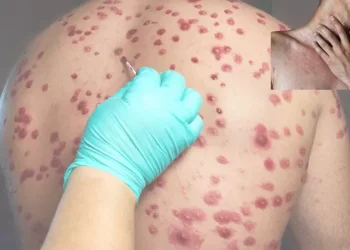 Deadly Flesh-Eating Bacteria Spreads Across Texas