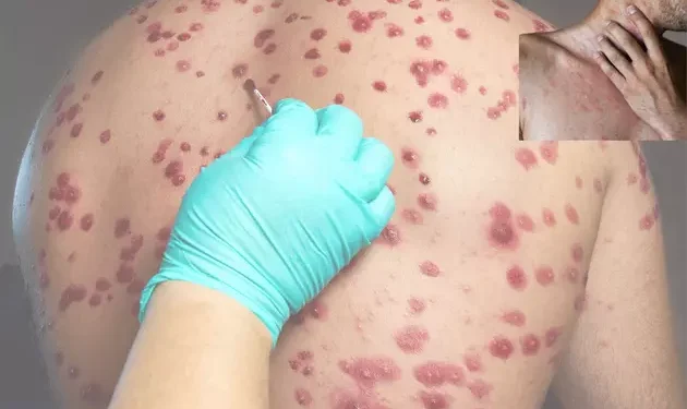 Deadly Flesh-Eating Bacteria Spreads Across Texas